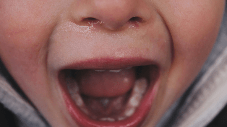 Close up of a Childs mouth and nose. The child is screaming/crying